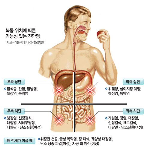 과민성대장증후군 사진