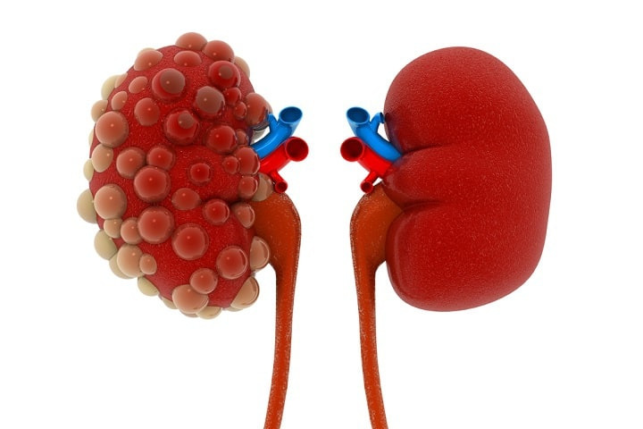 콩팥병관련사진