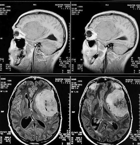 뇌수막종 사진