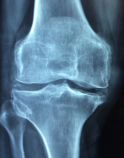 무릎 인공 관절 수술 비용 지원 사업-연골 마모