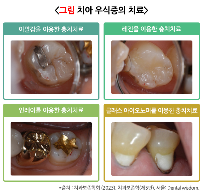 치경부위 충치치료-글래스아이오노머치료-국가건강정보포털이미지