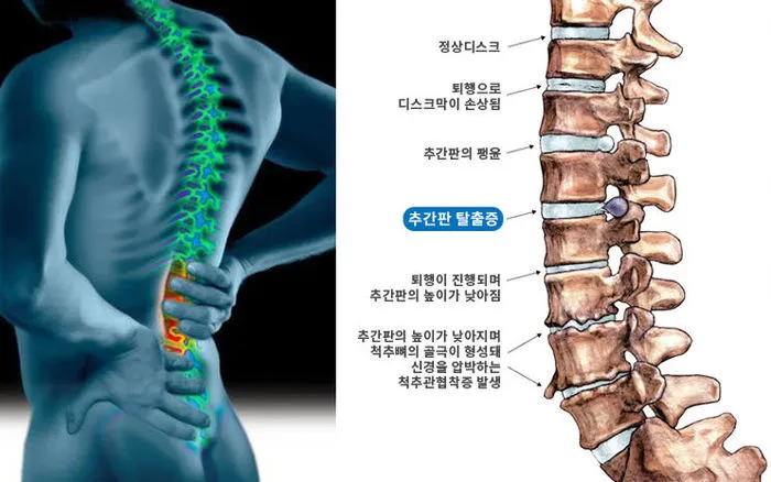 허리디스크 통증 원인 치료법_1