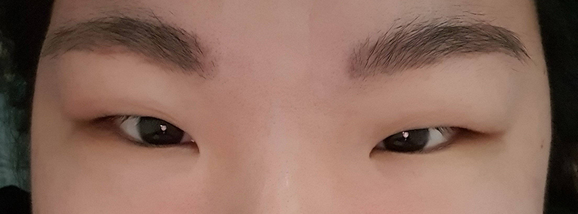  쌍꺼풀 수술 당일 후기/쌍꺼풀 절개+앞트임+뒷트임
