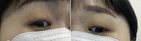 아이라인반영구 21