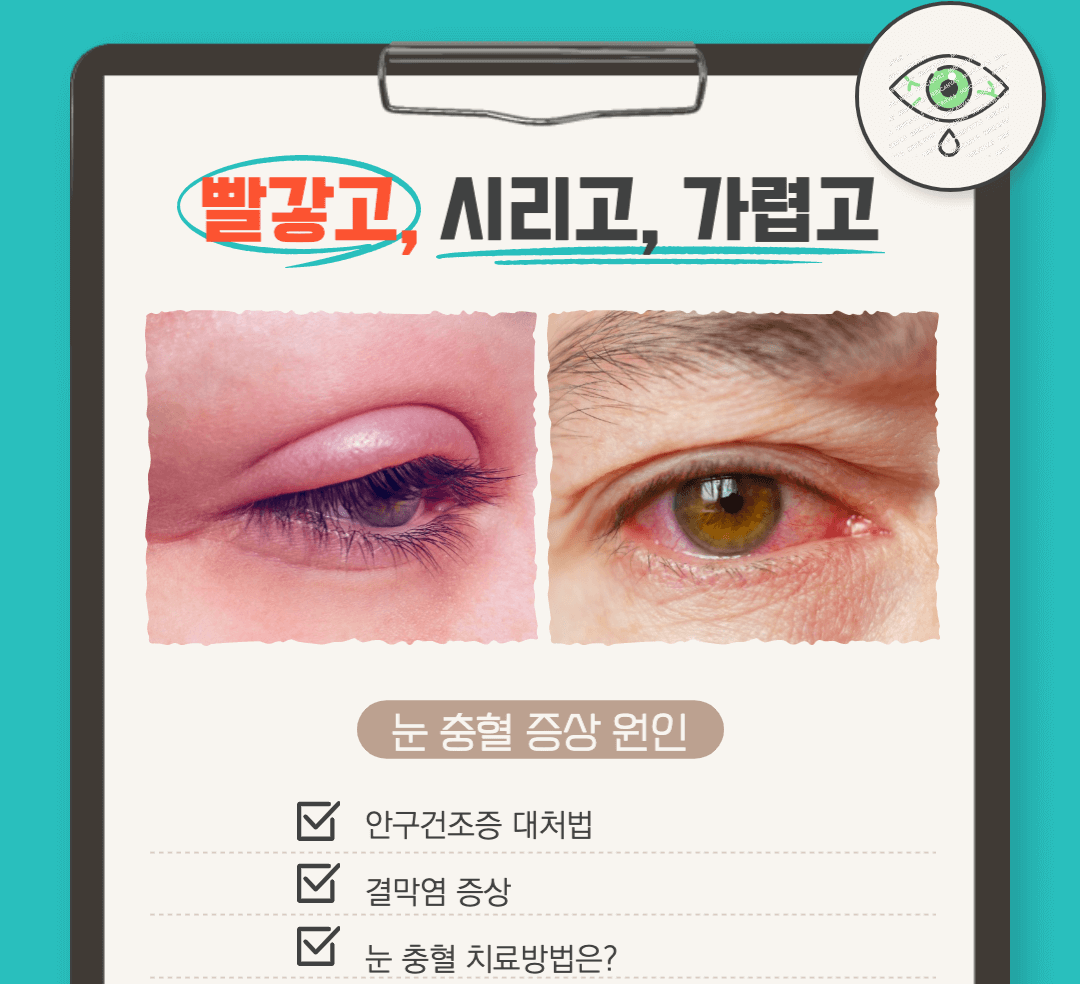 눈 충혈 원인 증상 결막염 안구건조증 약