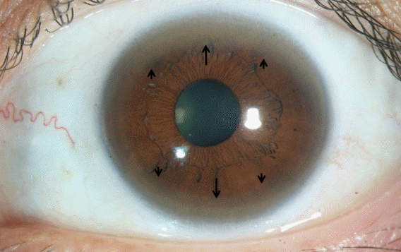 눈동자의 회색 링 (Kayser-Fleischer Ring)