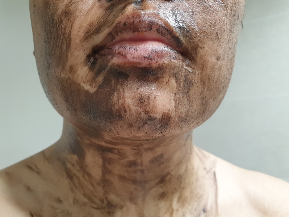  예민한 복합성 피부에 새로운 선택지가 될 코스메쉐프 흑당고 7개월 사용후기 리얼리뷰 [내돈내산][찐리뷰]