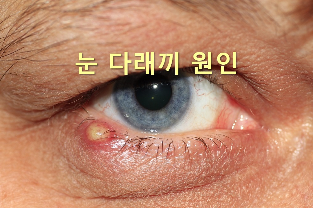  눈 다래끼 빨리 낫는 법과 눈 다래끼 원인