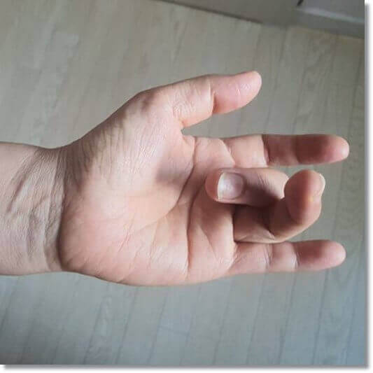 방아쇠수지증후군 원인&#44; 방아쇠수지증후군 환자 손 사진