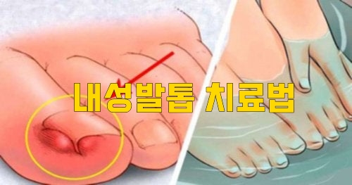  내성발톱 치료법