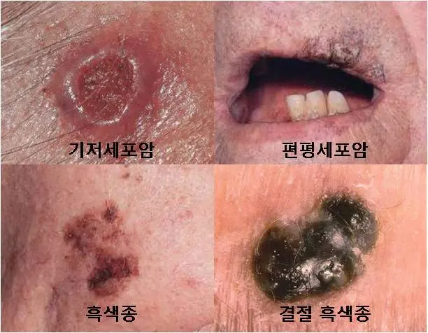 흑색종양