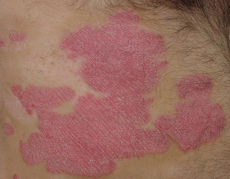 판상형 건선 (plaque psoriasis)