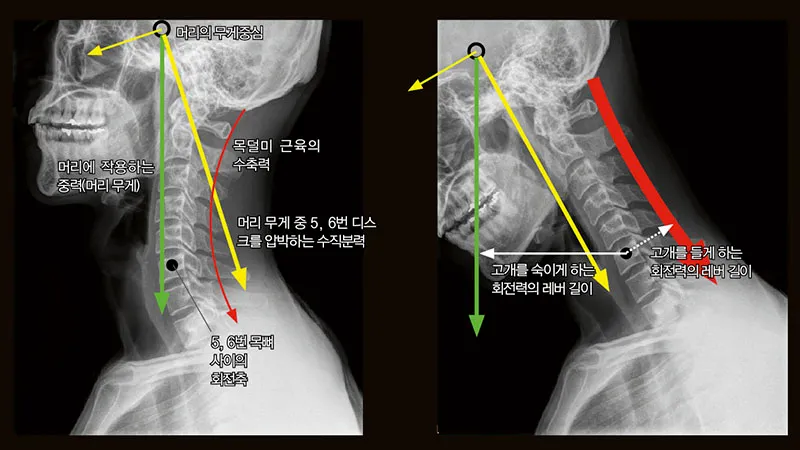 목디스크에 좋은 운동