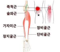 오금이 아픈 이유