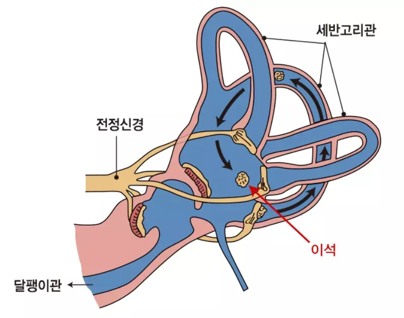 이석증 원인