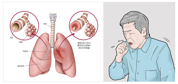 페그림 남자 가래