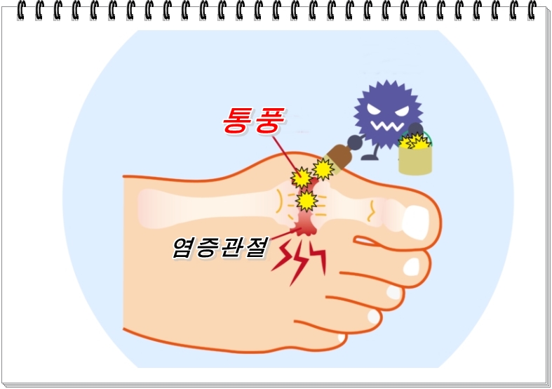  통풍을 빨리 낫게 하려면? 통풍의 원인이나 치료 및 음식섭취