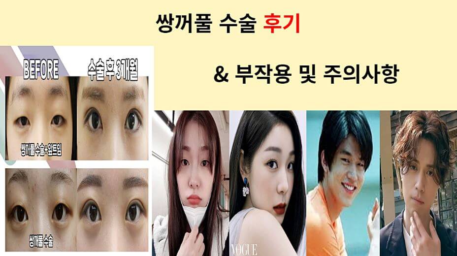 쌍꺼풀수술-후기-부작용-주의사항-주의사항