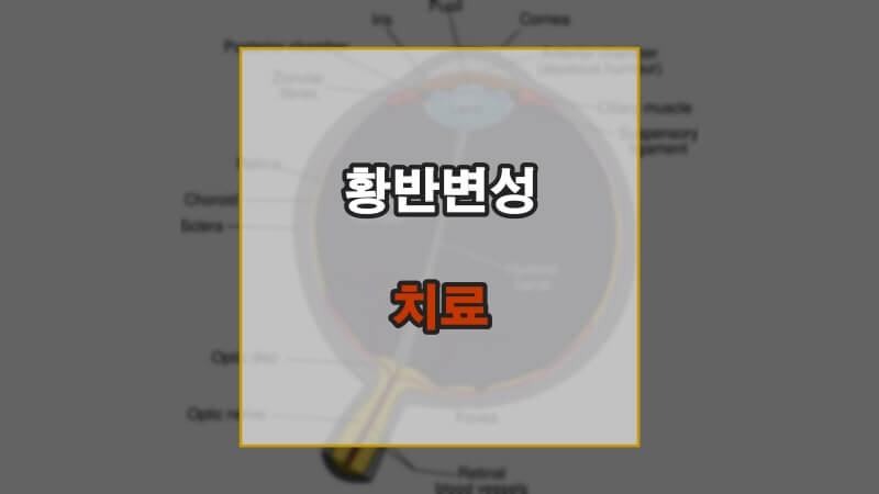 황반변성 나이관련황반변성 주사 치료 루테인