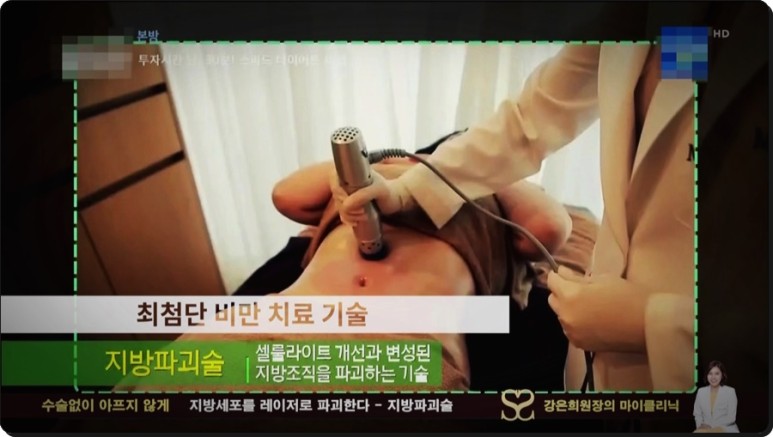 셀룰라이트 제거까지 지방파괴술 효과, 뱃살 다이어트부터 복부 17