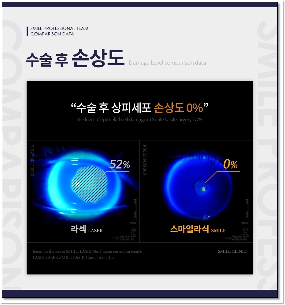 라섹회복기간 1일 13
