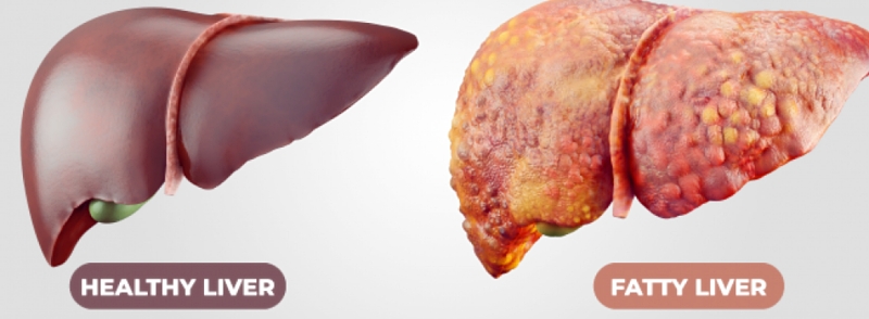Healthy liver and fatty liver image