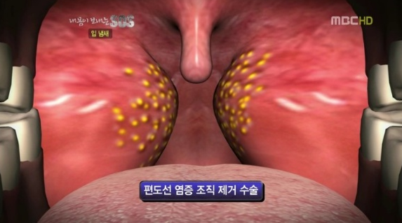  편도결석 빼는법 자세히 알아보세요