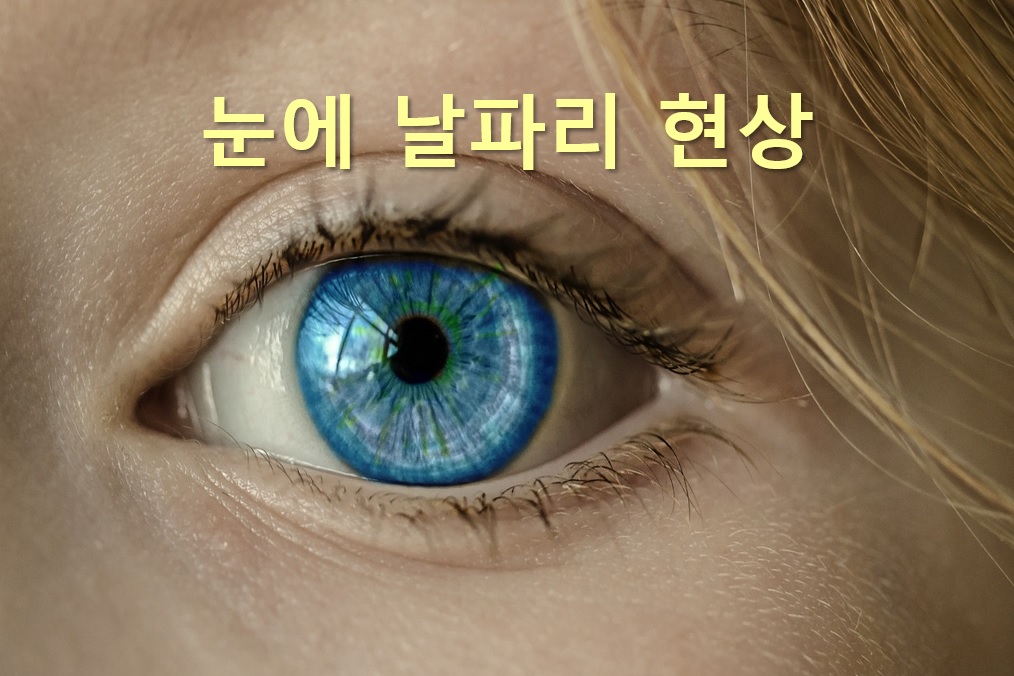 눈에 날파리 현상과 눈에 검은 점이 보일 경우의 증상은