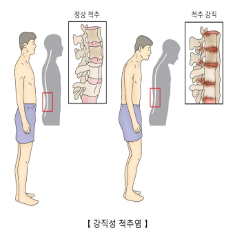 강직성척추염