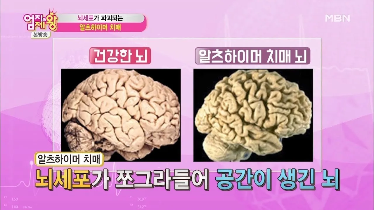 알츠하이머와 치매 차이_1
