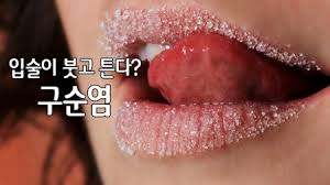 구순염 증상과 치료
