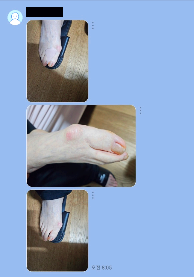 네이버 톡톡 캡처화면 속 발 사진 세 장 - 첫 번째 사진에서 무지외반용 오토제 분홍색 보호 패드를 착용한 발 - 두 번째 사진은 발 옆 염증 부위 클로즈업 - 세 번째 사진은 슬리퍼를 신은 발 전체 모습 - 오전 8시 5분 메시지 전송 시간 표시.