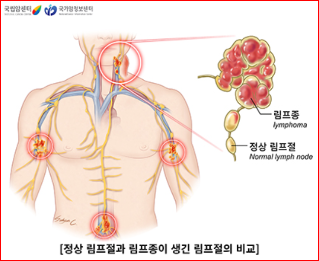 출처; 국가암정보센터, 정상 림프절과 림프종의 림프절 비교