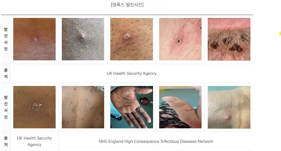 엠폭스 원숭이두창 발생 사진