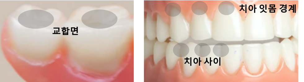 교합면&#44; 치아사이&#44; 치아-잇몸 경계