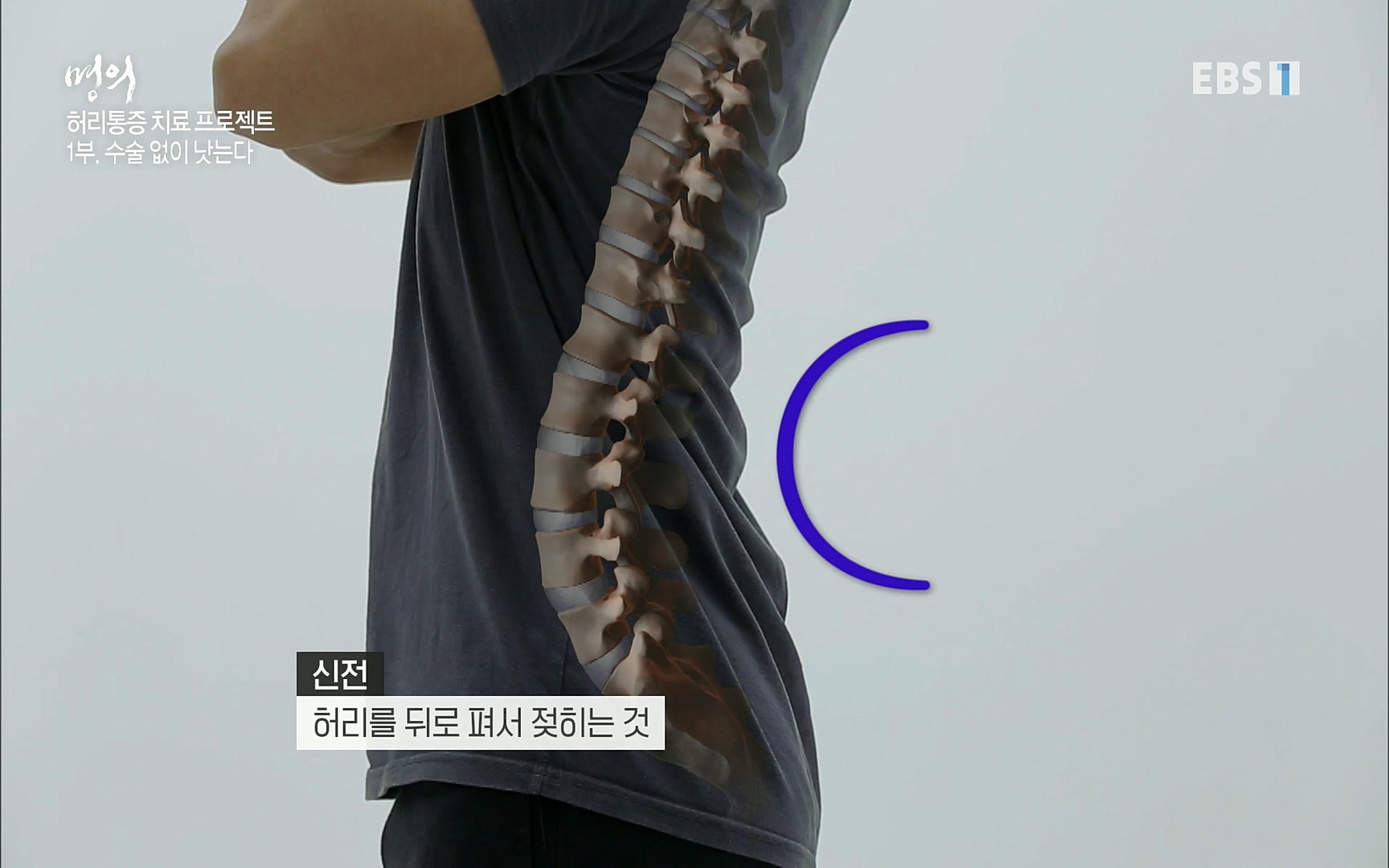 EBS 명의 헬스케어 - TV - 교육의 중심 EBS허리 통증 치료 프로젝트 1부, 수술없이 낫는다 .mp4_20220712_203953.994.jpg