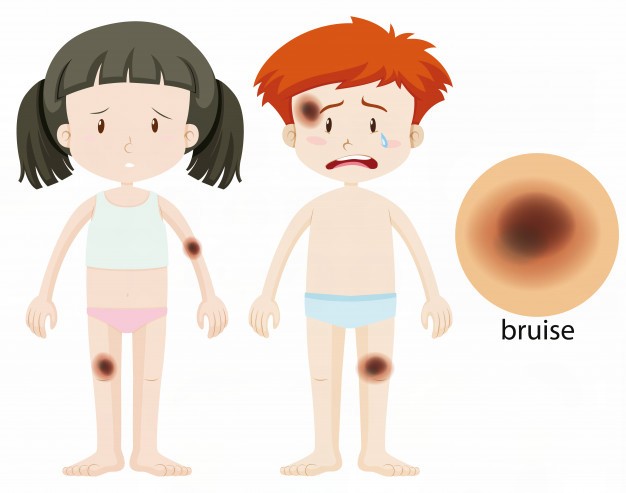  멍 빨리 빼는법 꿀팁