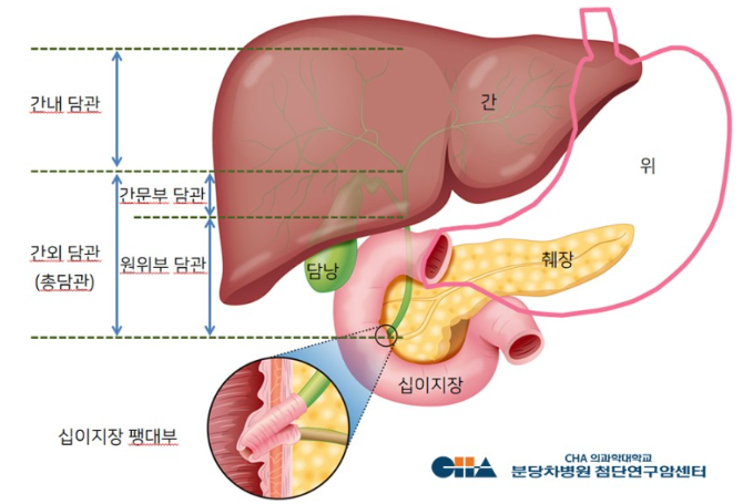  [담낭암 #1] 생존율이 낮고 예후가 좋지 않은 담낭암, 그 원인은?