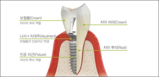 충남 공주시 공주 임플란트 비용 가격 잘하는 치과 저렴한 싼 곳 추천 의원 병원 오스템 원데이 수면 틀니 전체 상악 뼈이식 앞니 어금니