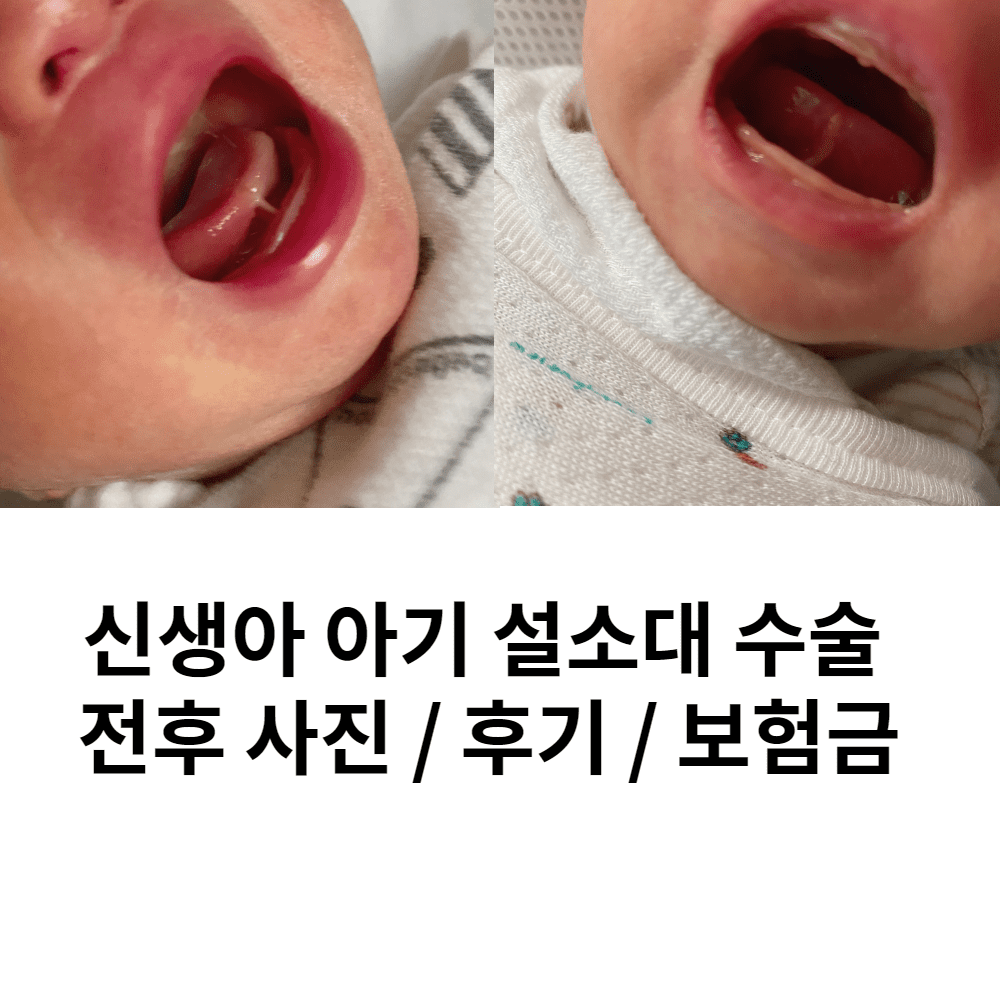 아기 설소대 수술 전후 사진 (단설소대)