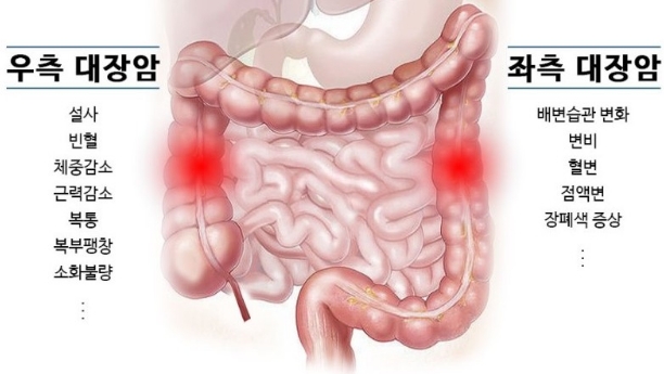 대장암 초기증상 원인 자가진단 예방법 정보 총정리4