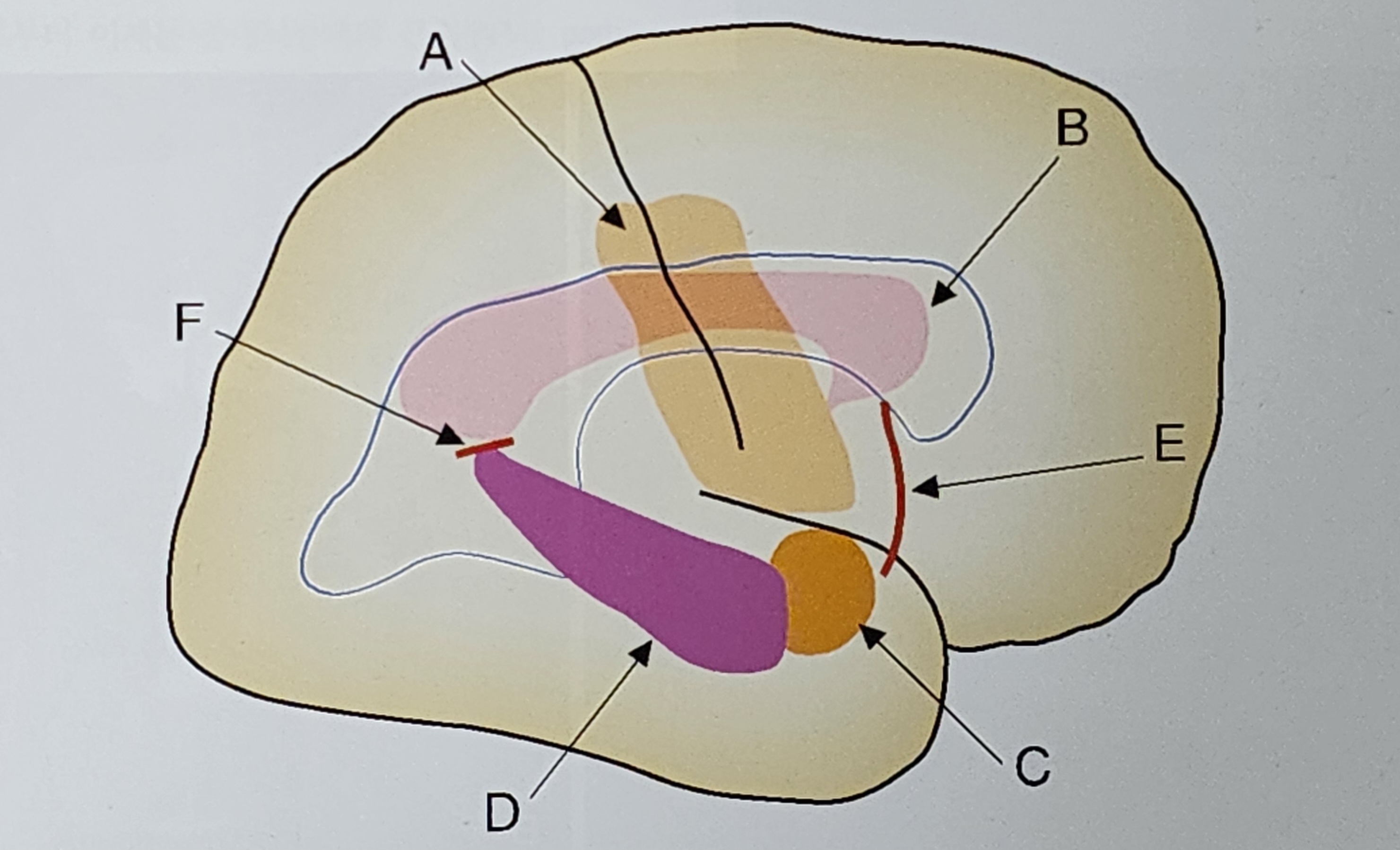 대뇌반구절제술(Hemispherectomy)