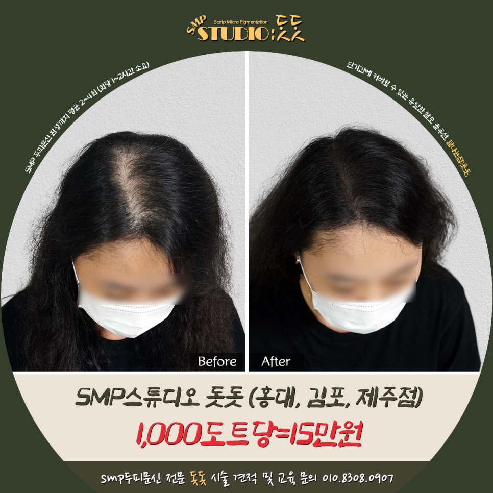  여자 정수리 탈모 두피문신으로 후회없이 극복하기
