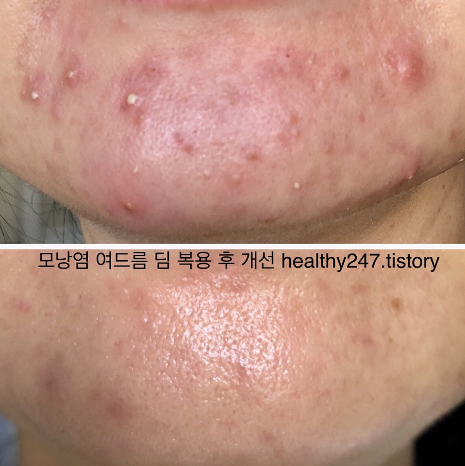턱-여드름-모낭염-사진
