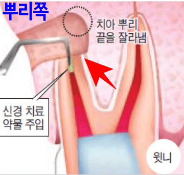 치근단-절제술