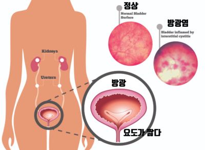 방광염 증상