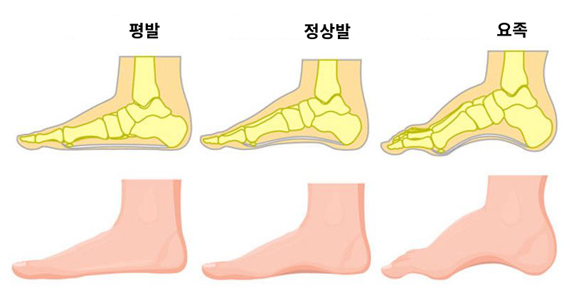 평발-정상발-요족-비교-사진