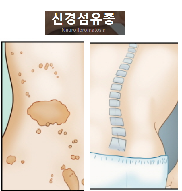  신경섬유종 초기증상 가지