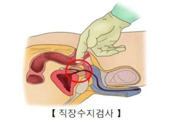 직장암 3기 전이 항암치료 로봇수술_16