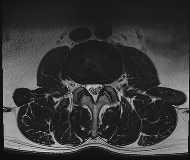 척추관 협착증이 없는 MRI 사진